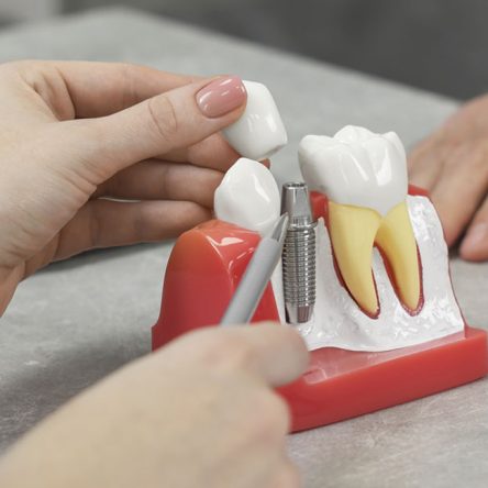 Dental Implants