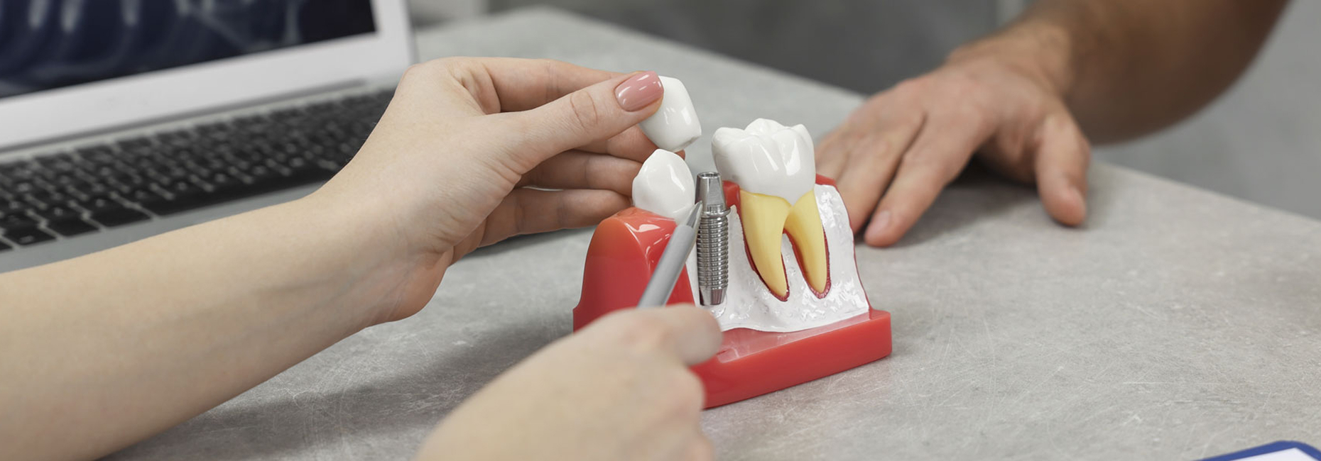 Dental Implants