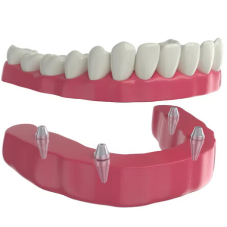 Smile Restoration: The Power of Dental Bridges Unveiled
