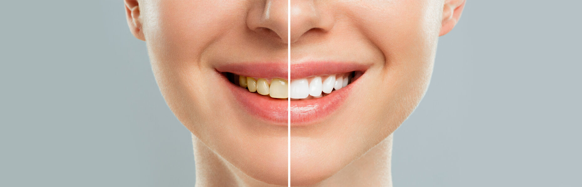 Can Yellow Teeth Become White Again? Exploring Effective Whitening Solutions.