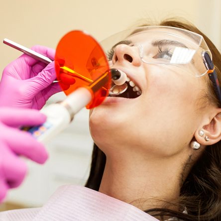 5 Secret Benefits of Teeth Whitening