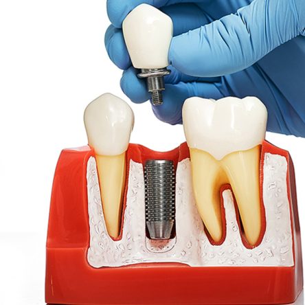 Why Dental Implants Are Low-Maintenance