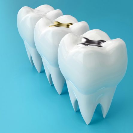 What to Expect Before, During, And After a Dental Filling?